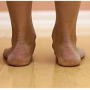 Flat feet