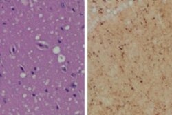 Staining (Left) shows spongiform degeneration. Staining (Right) shows intense misfolded prion protein.