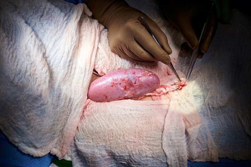 U.S. surgeons successfully test pig kidney transplant in human patient