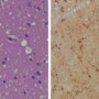 Staining (Left) shows spongiform degeneration. Staining (Right) shows intense misfolded prion protein.