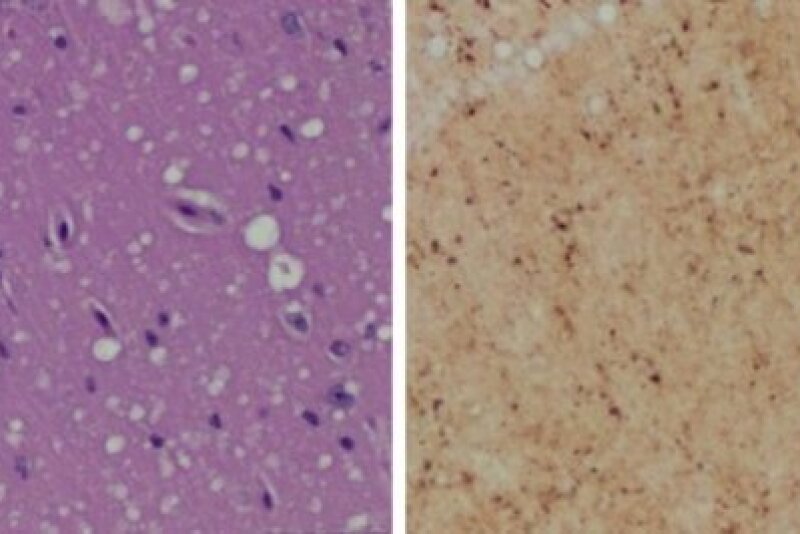 Staining (Left) shows spongiform degeneration. Staining (Right) shows intense misfolded prion protein.