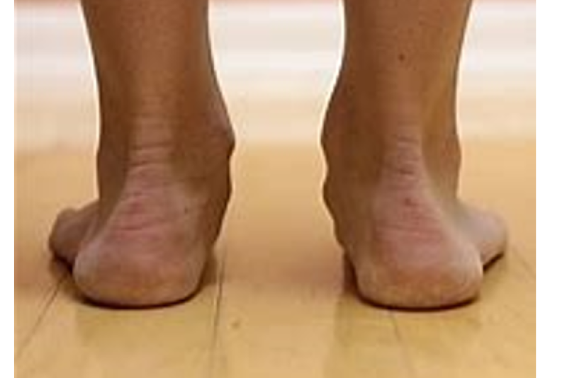 Flat feet