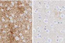 In these images of mouse brain infected with scrapie, the image on the left was treated with an inactive ASO and shows prion accumulation (brown). The image on the right was treated with an active ASO and shows little accumulation at a comparable timepoint.
