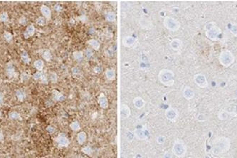 In these images of mouse brain infected with scrapie, the image on the left was treated with an inactive ASO and shows prion accumulation (brown). The image on the right was treated with an active ASO and shows little accumulation at a comparable timepoint.